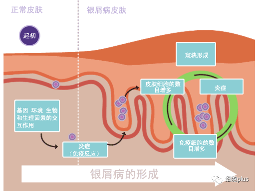 湘雅医院发布最新干细胞治疗银屑病结果，女性比男性更有效，有效率高达67%