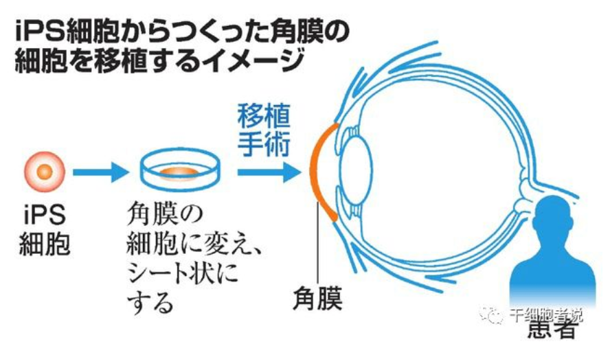 iPSC细胞疗法在日本的临床研究