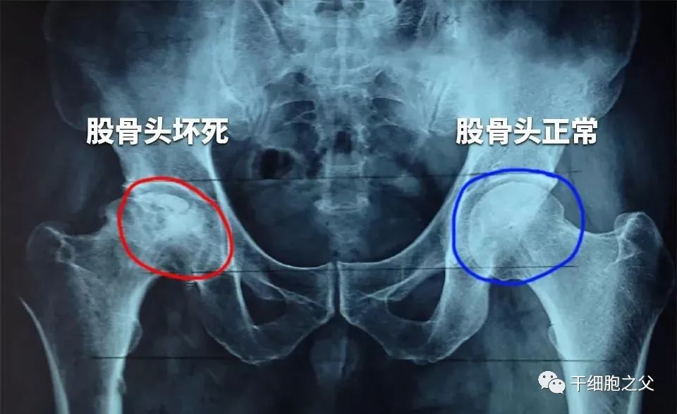 干细胞移植治疗116例股骨头坏死的前瞻性临床研究