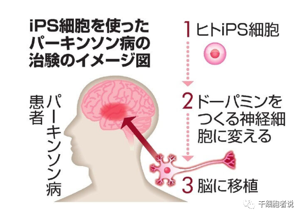 iPSC细胞疗法在日本的临床研究