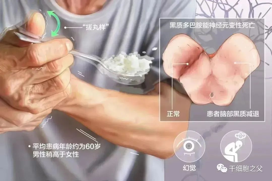 30例干细胞移植治疗帕金森的临床研究案例