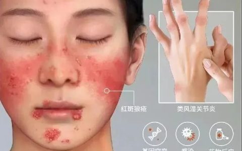间充质干细胞：80多种自身免疫性疾病治疗的新选择