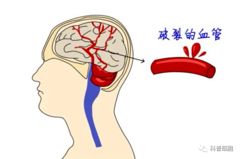 干细胞可以治疗脑出血吗？