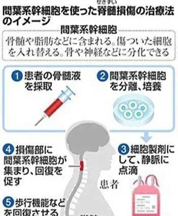 干细胞在脊髓损伤修复中的临床进展，10名患者从中获益