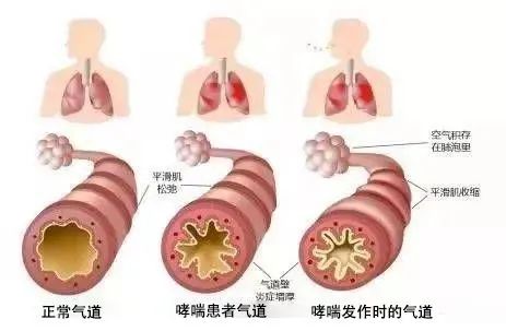 干细胞技术有望实现“呼吸自由”