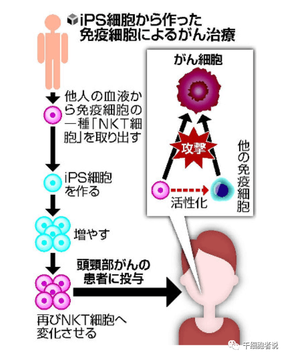 iPSC细胞疗法在日本的临床研究