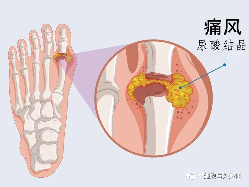 郭麒麟患痛风，干细胞成为治疗痛风新疗法