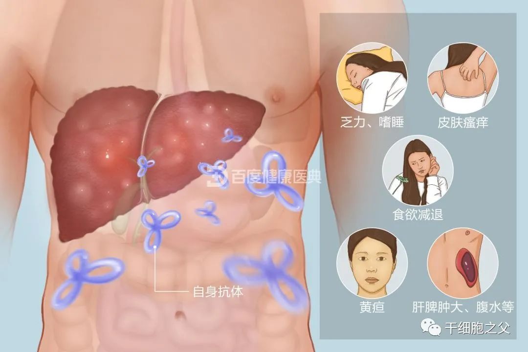 干细胞治疗7例自身免疫性肝病的临床疗效和安全性观察