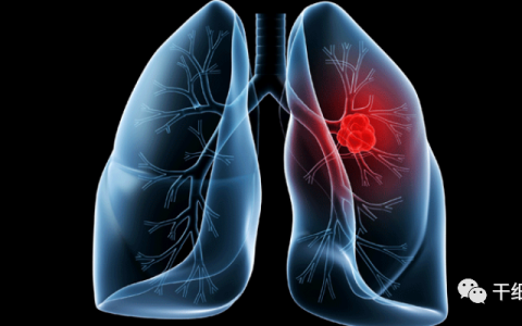 NK细胞在肺癌治疗中的应用