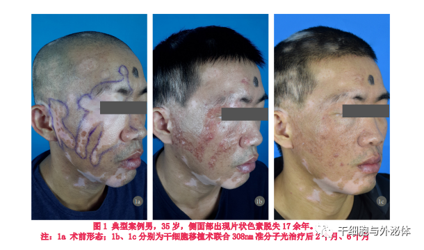 冯小刚患白癫风，干细胞治疗白癫风临床潜力巨大