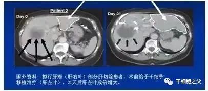 干细胞 — 亚健康的天敌，人体健康的保障