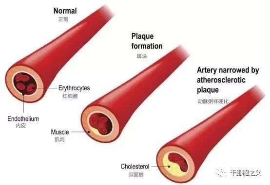 干细胞可改善高血脂指标，有效预防“三高”并发症！