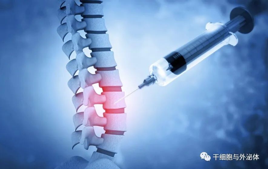 外泌体注射治疗坐骨神经痛和退行性椎间盘疾病效果显著