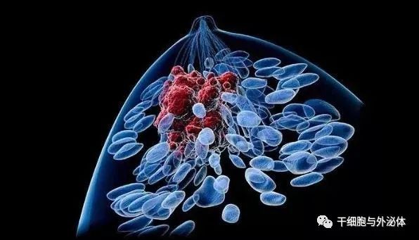 NK细胞在乳腺癌治疗中的应用
