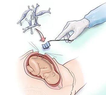 用干细胞给胎儿打“补丁”，3名脊柱裂患儿接受全球首批宫内干细胞手术