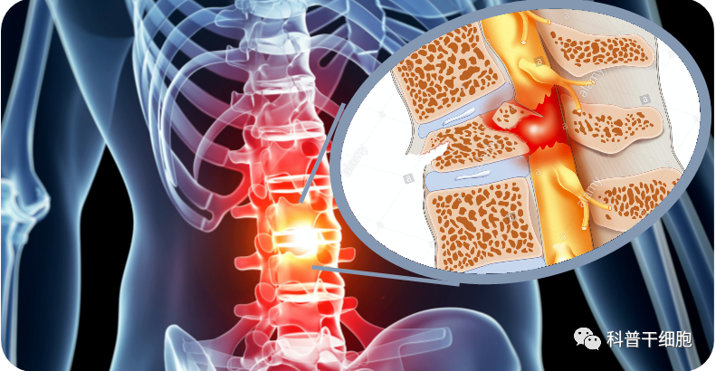 治疗脊髓损伤异体干细胞专利获批