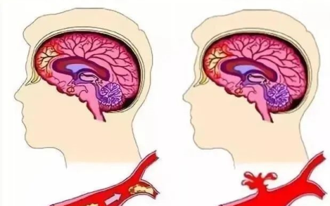 中风致死率、致残率很高，干细胞治疗案例让患者看到新希望
