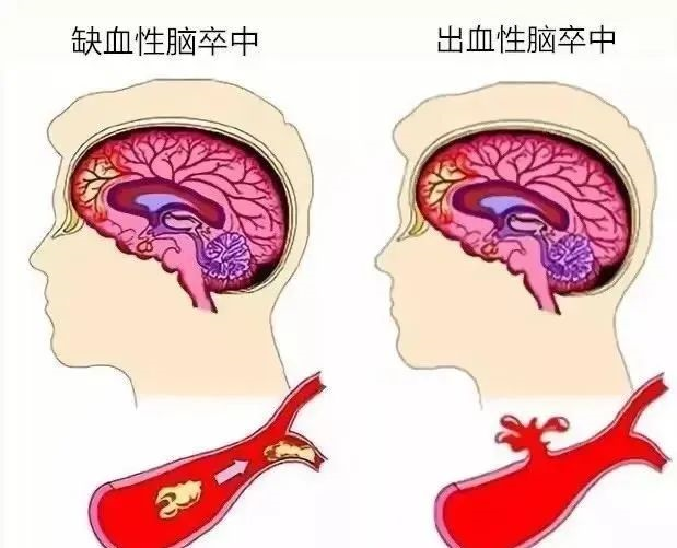 中风致死率、致残率很高，干细胞治疗案例让患者看到新希望