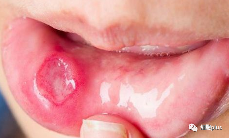 研究证明，磨人的口腔溃疡，间充质干细胞能帮忙