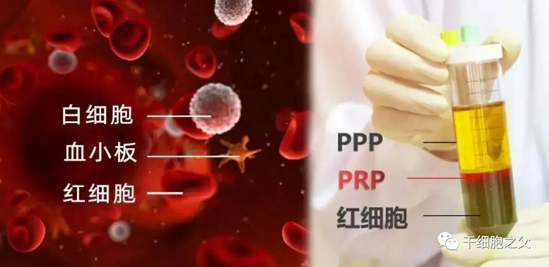 PRP卵巢回春术：神奇的PRP助48岁患者恢复生育能力