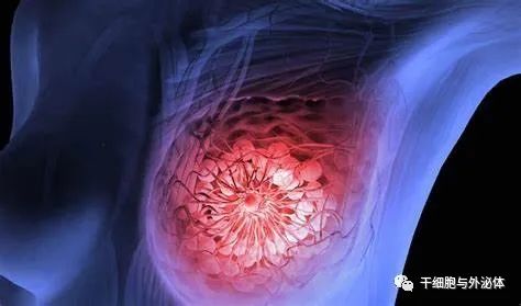CIK系列三 | CIK细胞对乳腺癌患者的临床疗效