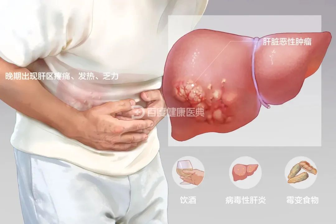 2022中国临床肿瘤学会（CSCO）肝癌诊疗指南：将CIK细胞疗法纳入肝切除术后辅助治疗策略