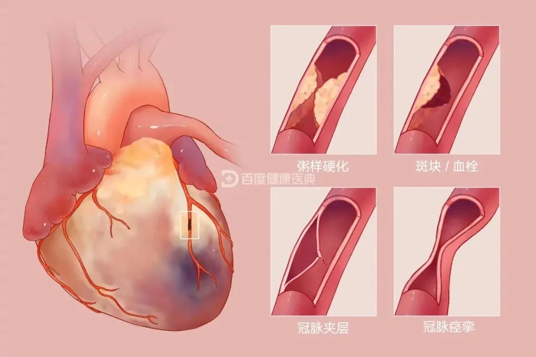 干细胞疗法-针对心肌梗死安全性与有效性的研究观察