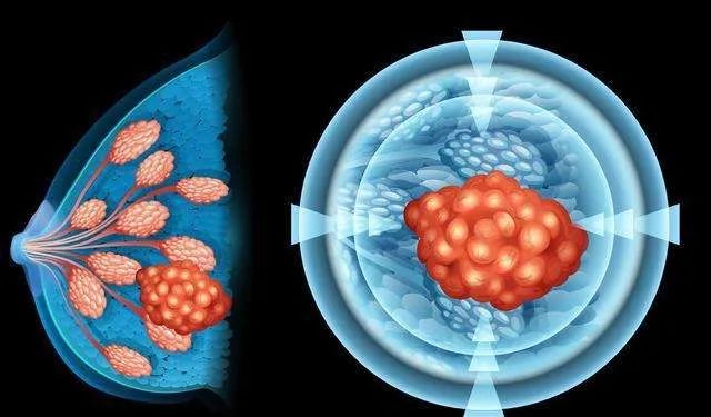 免疫细胞，乳腺癌治疗的“潜力股”