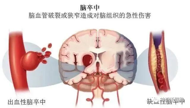 强大的旁分泌功能，干细胞能够有效缓解中风后脑损伤