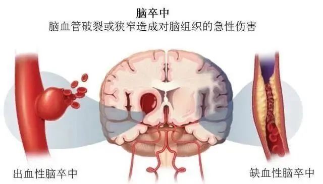 再生修复+旁分泌！《STEM CELLS》：干细胞可防止中风后进一步脑损伤