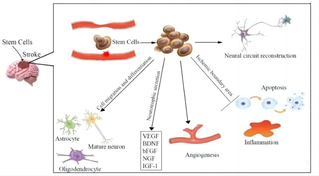 干细胞治疗缺血性脑卒中，能有效促进神经功能恢复