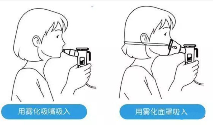 脐带干细胞外泌体雾化吸入法治疗鼻炎、肺炎、哮喘