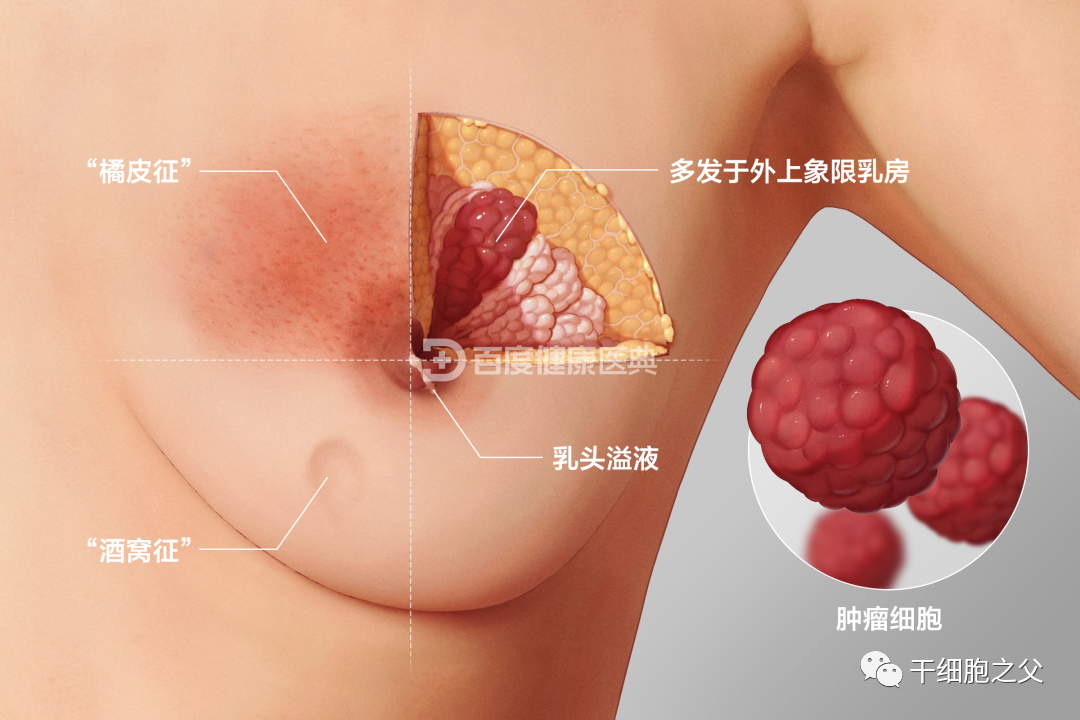 免疫疗法是乳腺癌术后辅助治疗的理想选择