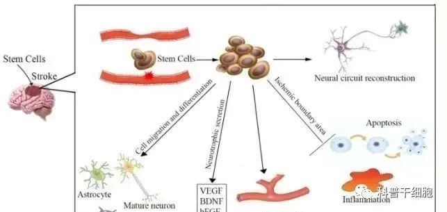 干细胞应用于缺血性脑卒中，能有效改善功能恢复
