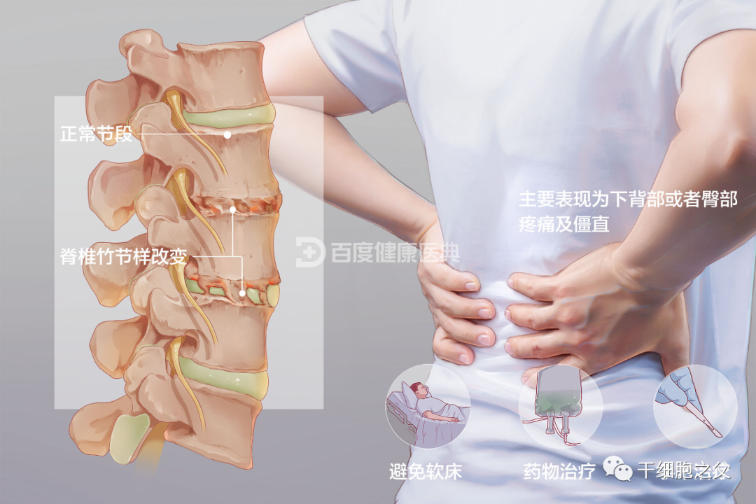 案例：干细胞治疗42例强直性脊柱炎的应用研究