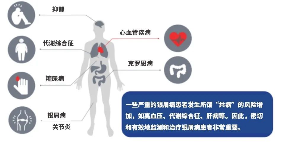 干细胞疗法在银屑病治疗中的临床应用及进展