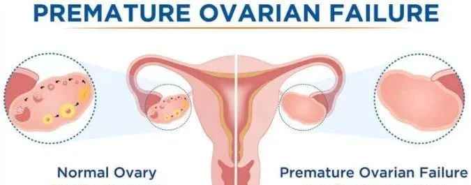案例 | 干细胞治疗卵巢早衰，有效改善卵巢功能