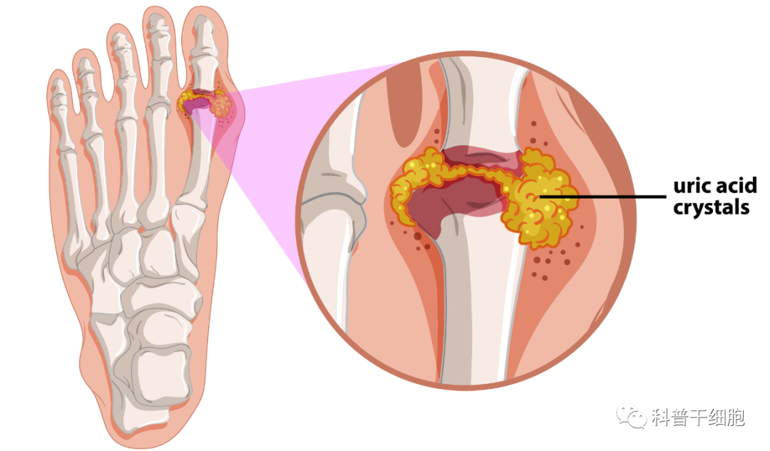 痛风救星，干细胞不仅“止”痛更“治”痛