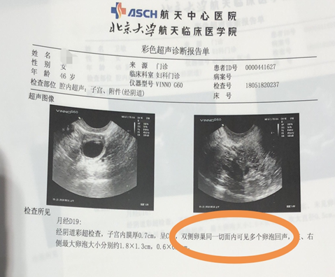 案例 | 干细胞治疗卵巢早衰，有效改善卵巢功能