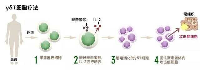 癌细胞“终结者”最强肿瘤杀手——γδT细胞