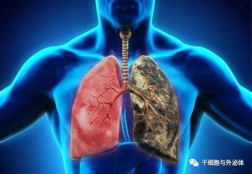 中南大学湘雅二医院新发现 | 阿司匹林可以抑制肺纤维化