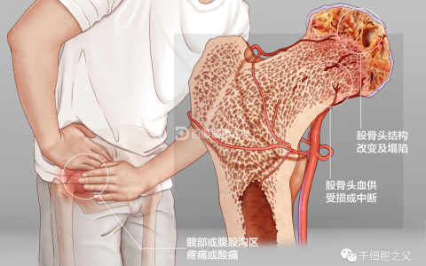 干细胞移植8例股骨头坏死的长期随访研究