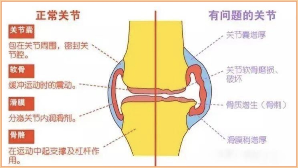 干细胞让软骨再生,治疗关节炎