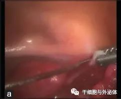 间充质干细胞疗法让绝经女性成功怀孕 | Stem Cell Rev and Rep