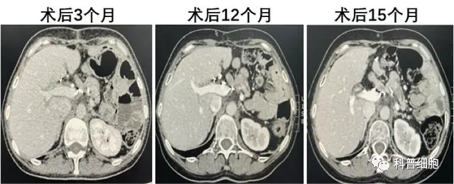 真实案例：胰腺癌多次治疗无果，细胞疗法显著延长生存期！