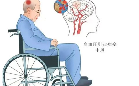 2项临床研究表明：干细胞治疗脑出血安全有效，潜力巨大！