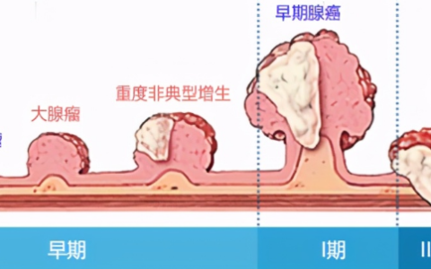 重大争议有答案！全身用同种异体间充质干细胞不会加重癌前病变发展！