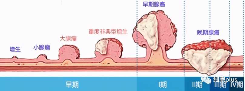 重大争议有答案！全身用同种异体间充质干细胞不会加重癌前病变发展！