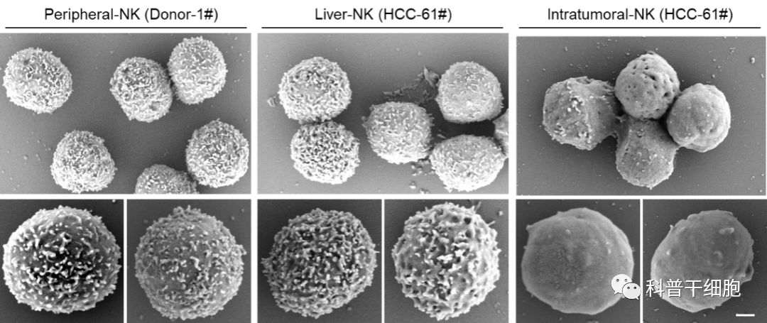 Nature子刊：中国科学技术大学发现NK细胞失去抗癌功能新机制