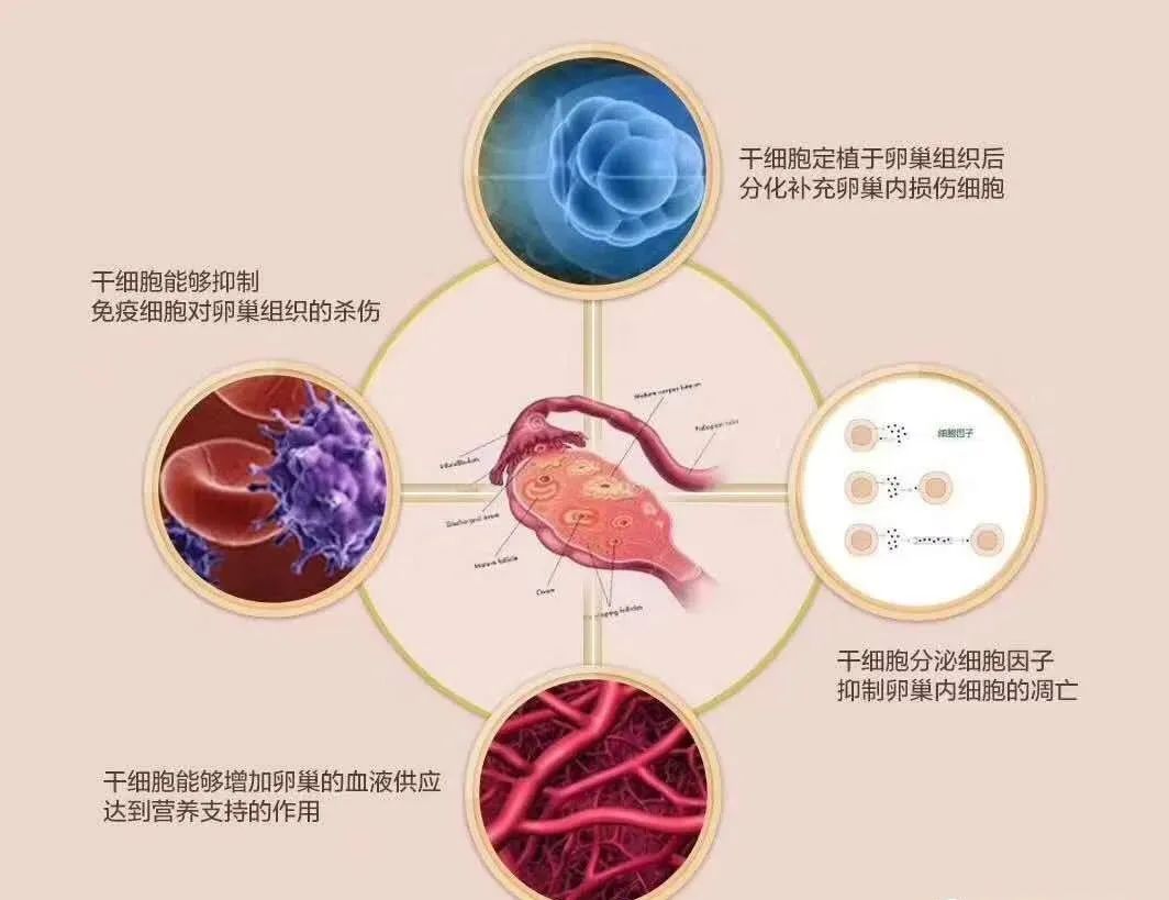 案例 | 干细胞治疗卵巢早衰，有效改善卵巢功能